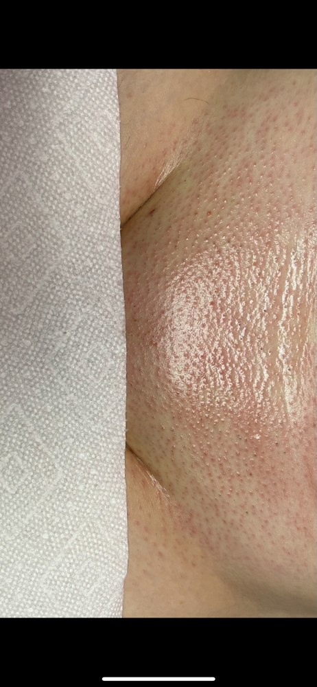 Brazilian (over 6 Weeks)