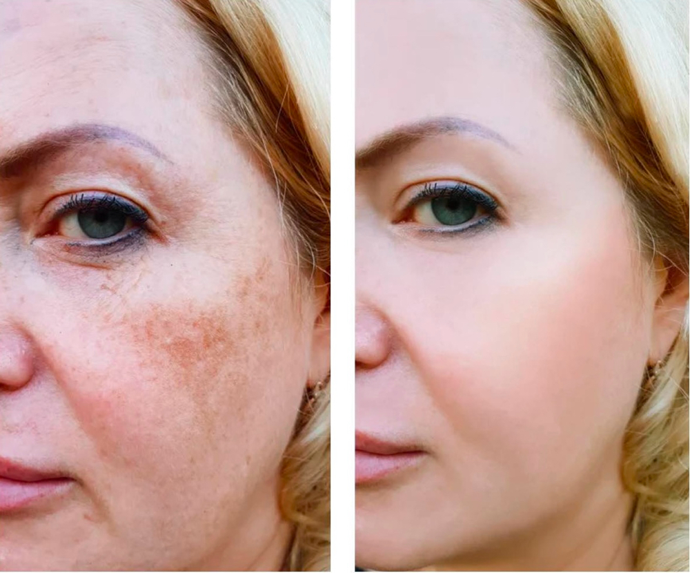 Laser-Facial Hyperpigmentation Tx