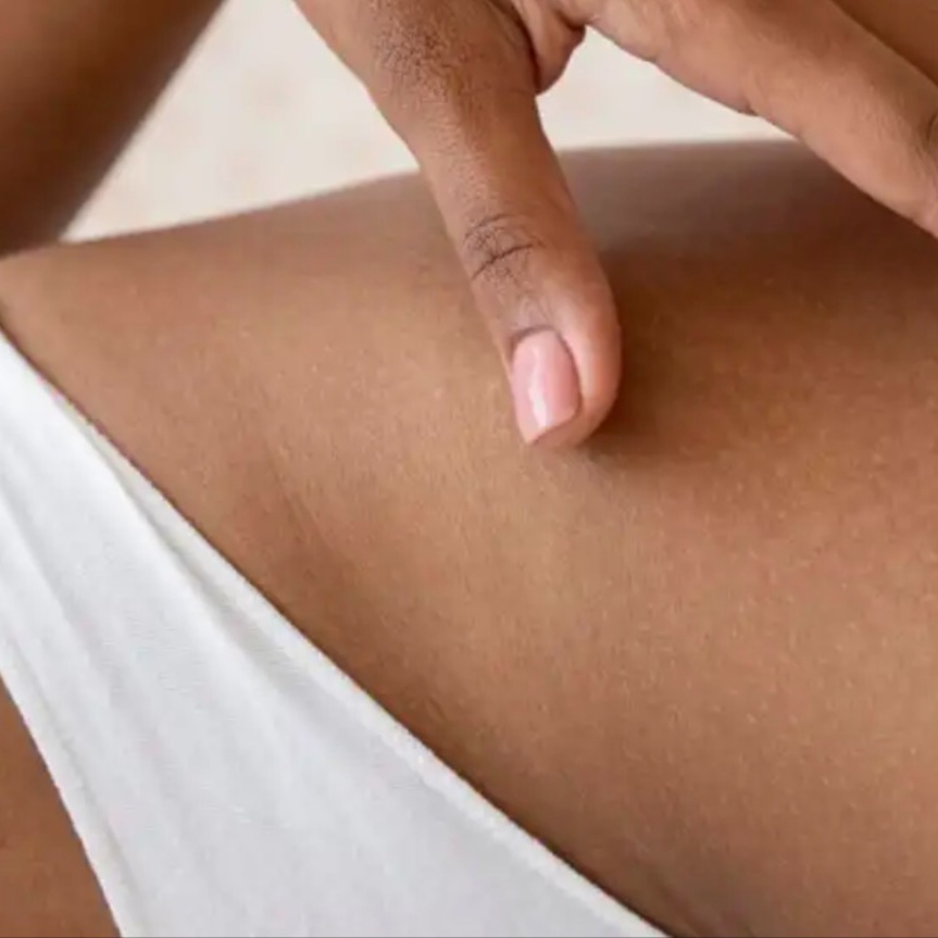 Bikini at KDM Derma Therapy in Centerton, AR
