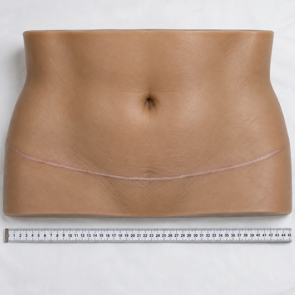 Extra large scars (over 12 inches) at Fine Arches in Woodside, NY