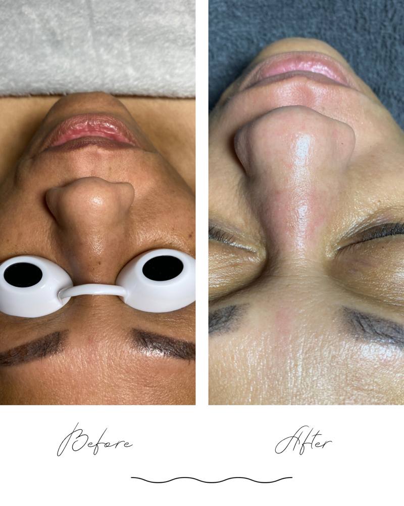 Microderabrasion Facial at Genie of Skin in Mooresville, NC