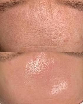 Renew Skin Peel