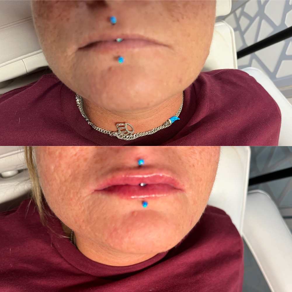 2ml Lip Filler