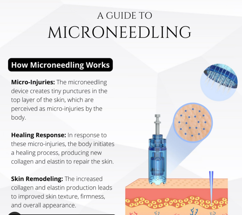 MicroNeedling (Add On Or Seperate)