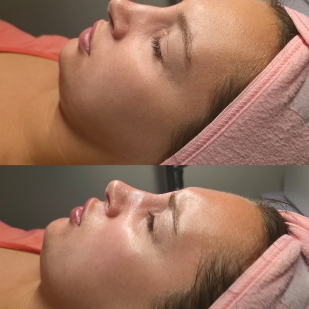 The Resurface- Dermaplaning Facial