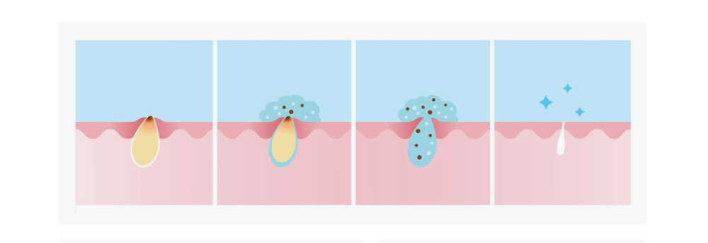 Blackhead Dissolver Facial at Carrie Tattershall in Greenwood, MO