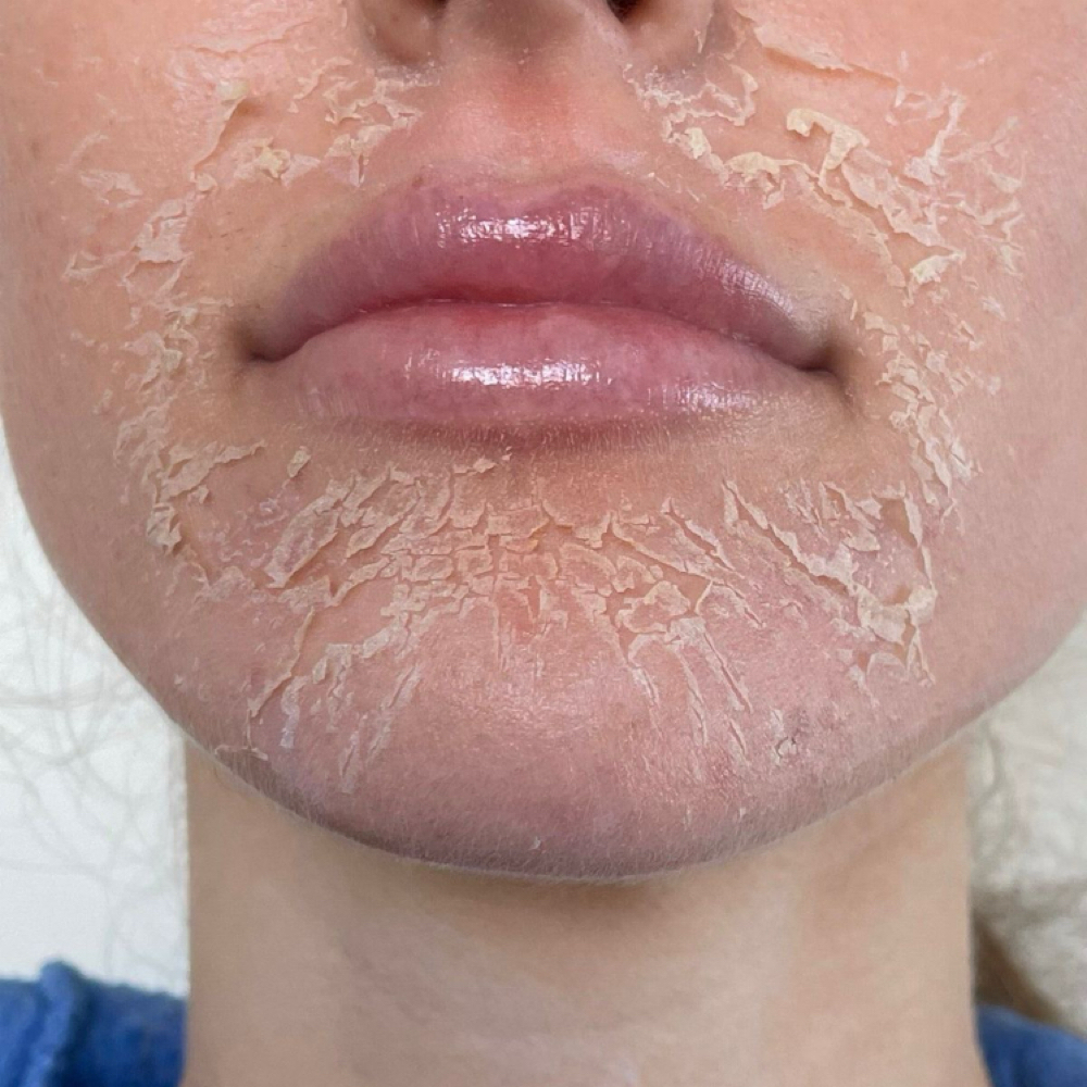 Chemicla Peel at Eres Bella Day Spa in Bell, CA