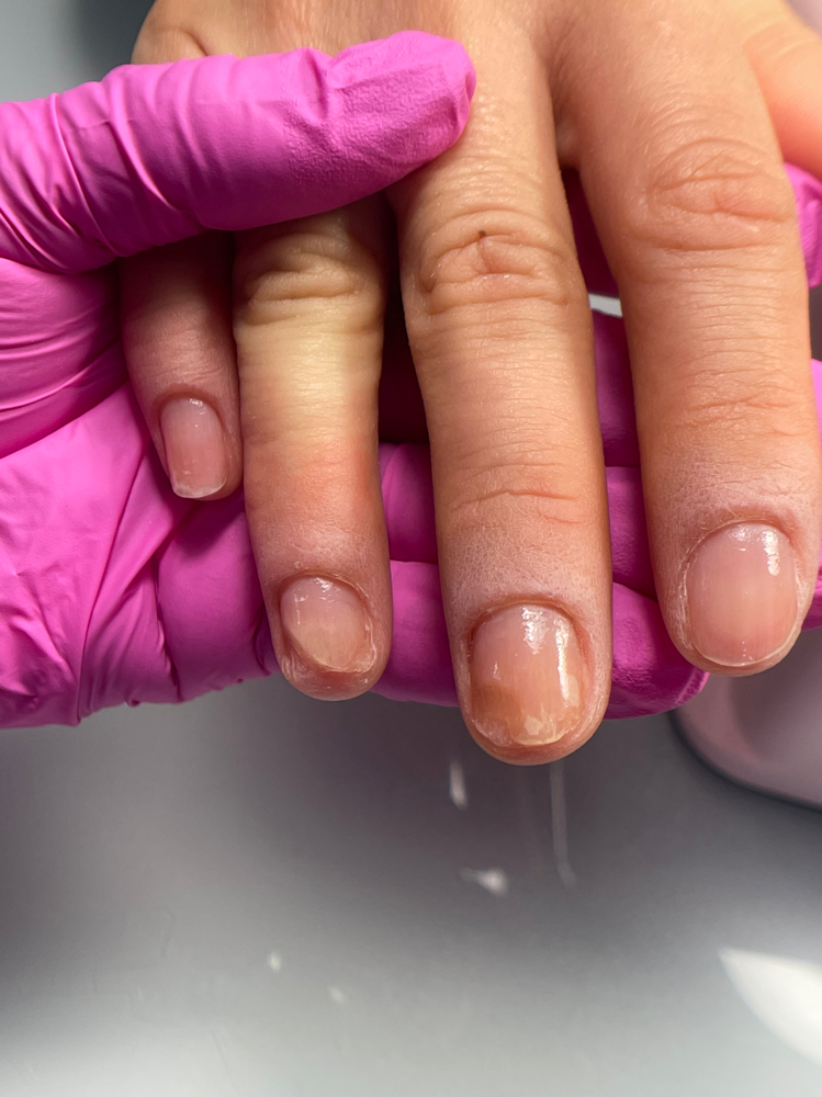 Cita Inicial Protesis Con Ibx 10uña