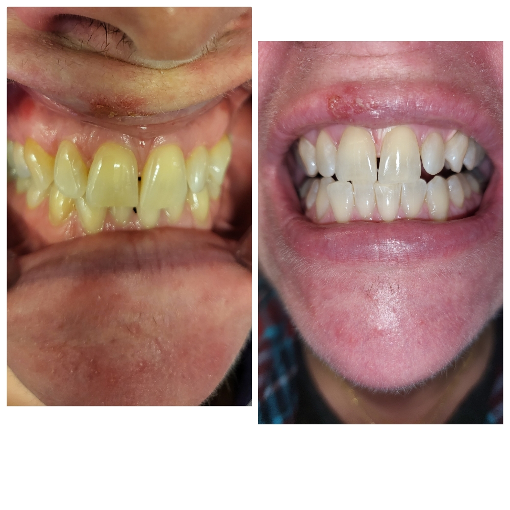 Couple's Teeth Whitening