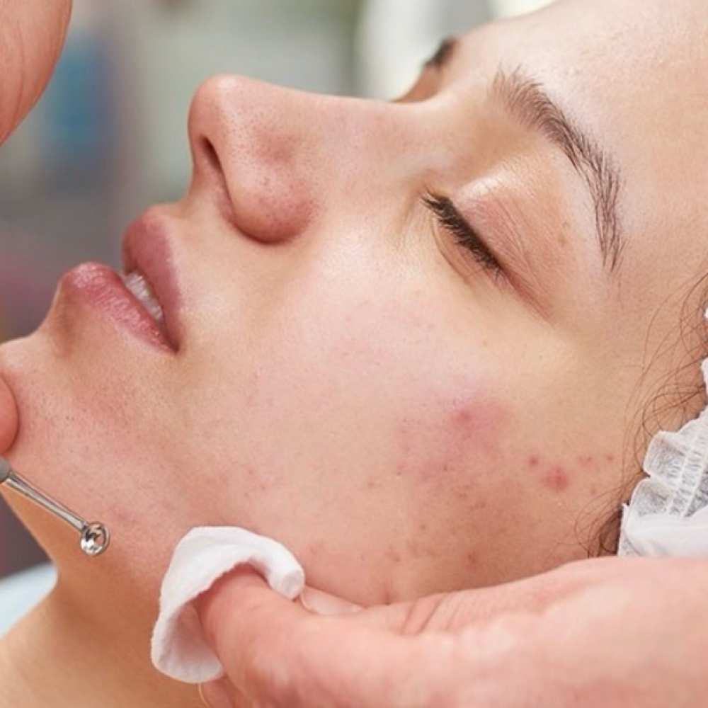 ✨ Acne Fighter Facial Package at JOCY’S BEAUTY & COSMETICS in Houston, TX