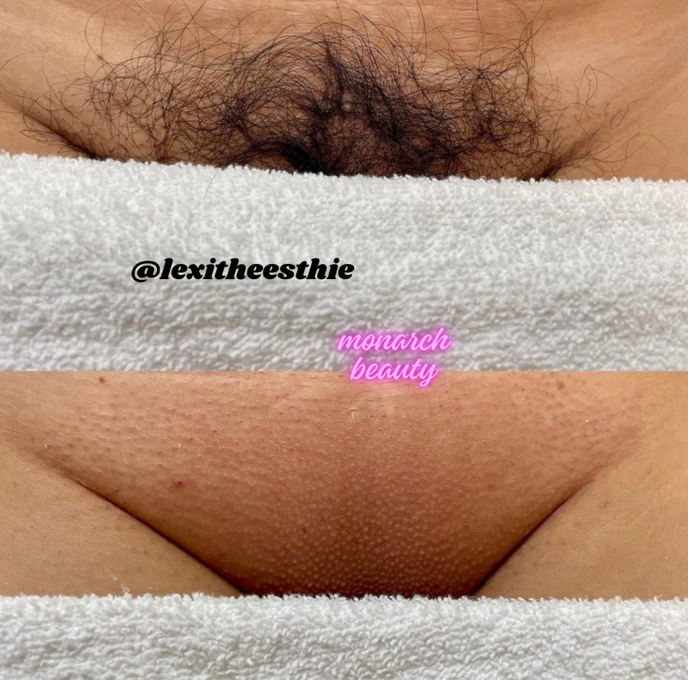 Vajacial W/brazilian Wax Included