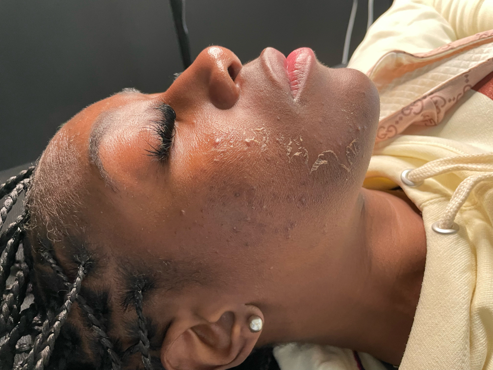 Chemical Peel