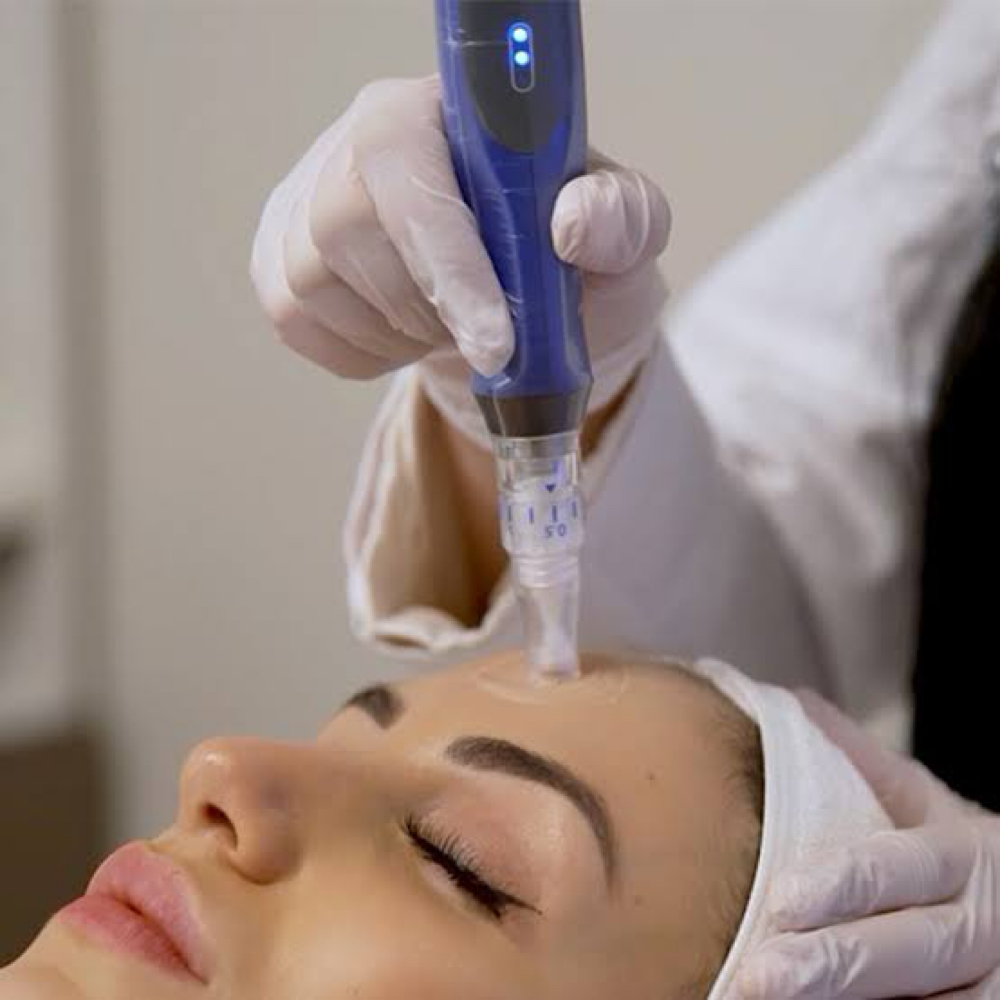 Microneedling Treatment