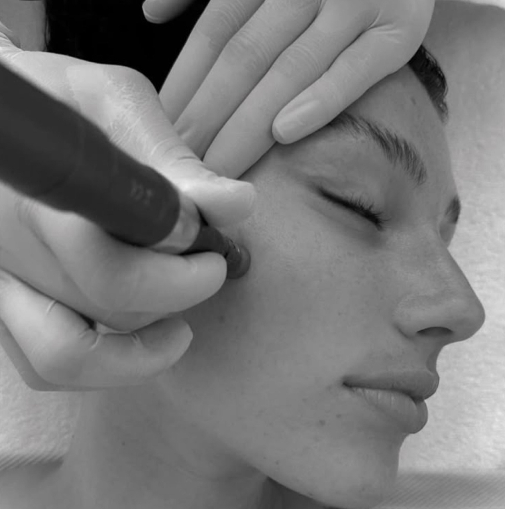 MICRODERMABRASION (Advanced Add On)