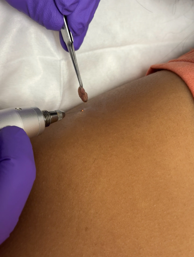 Skin Tag Removal