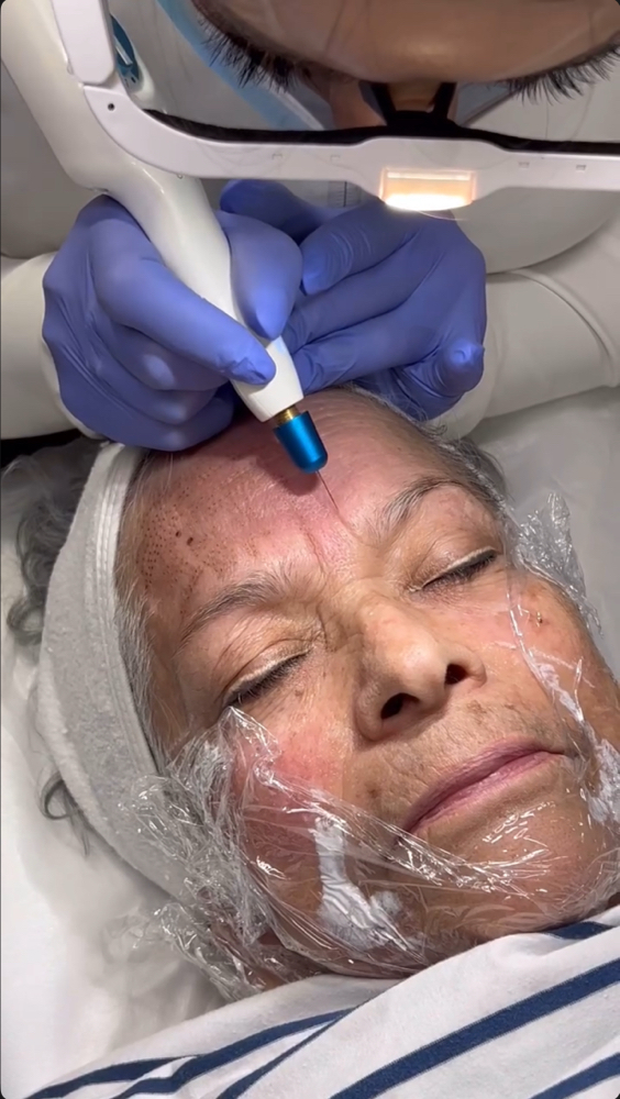 Fibroblast Plasma Pen