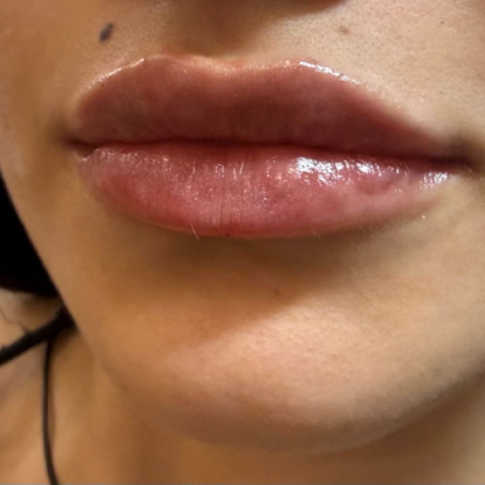 Lip Filler at Forever Beautiful Aesthetic Studio in Lake Jackson, TX