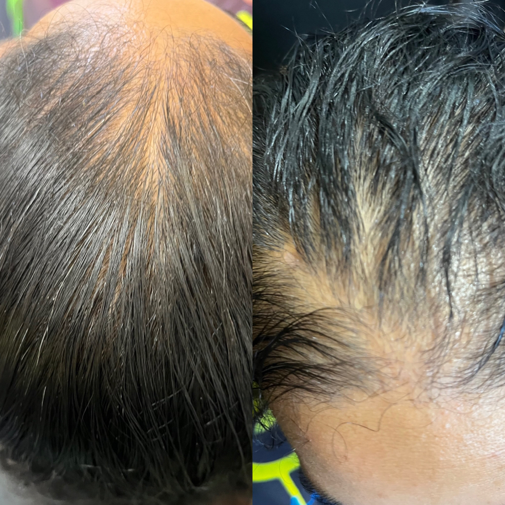 Hair Loss/scalp Treatment at Natural Iz Me in Fredriksted, VI