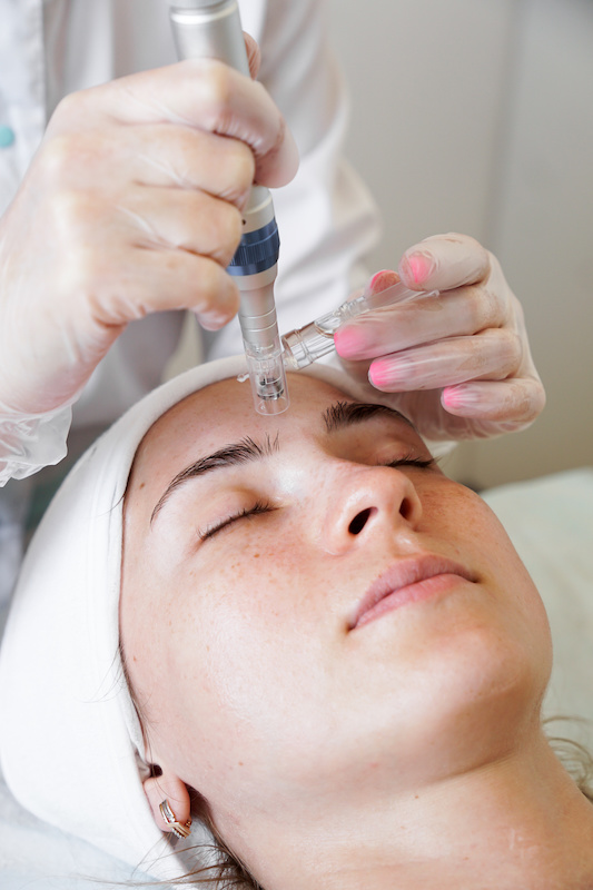 Microneedling at Eury’s Glow Esthetics in Methuen, MA