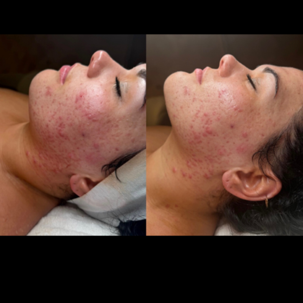 Oxygen Treatment + Dermaplane at Bare + Blended by Brittany in Henderson, KY