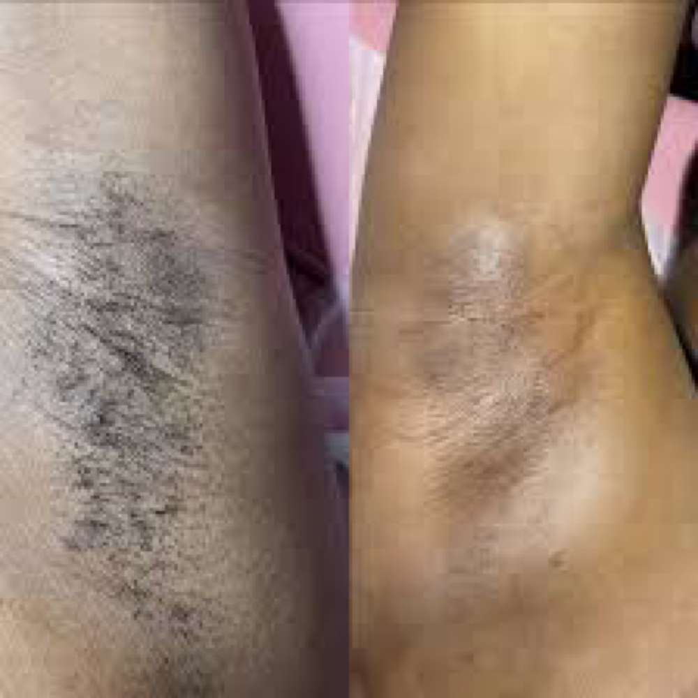Under Arm Waxing at EHT Spa in Valdosta, GA