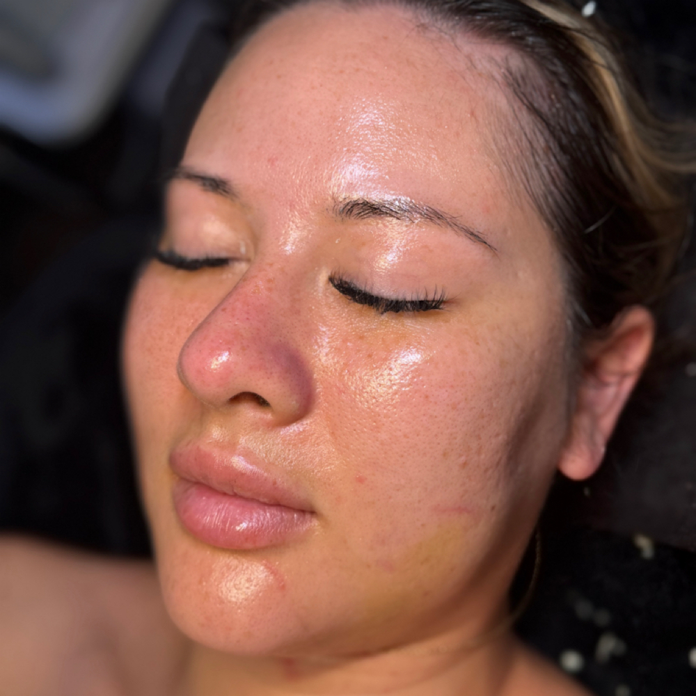 Summer Reset Facial at Elements of Esthetics in Arlington, TX