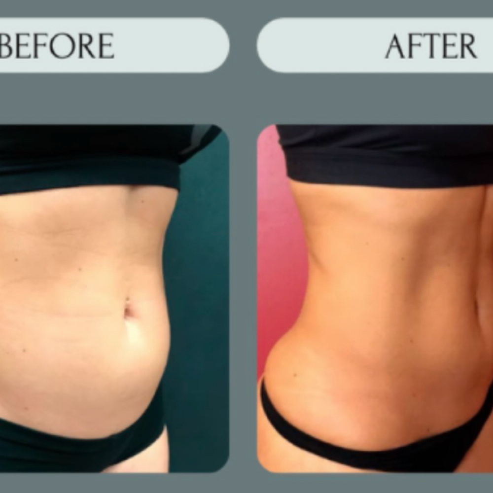 CryoSlim at LumenHeart with Chenoa in Loomis, CA