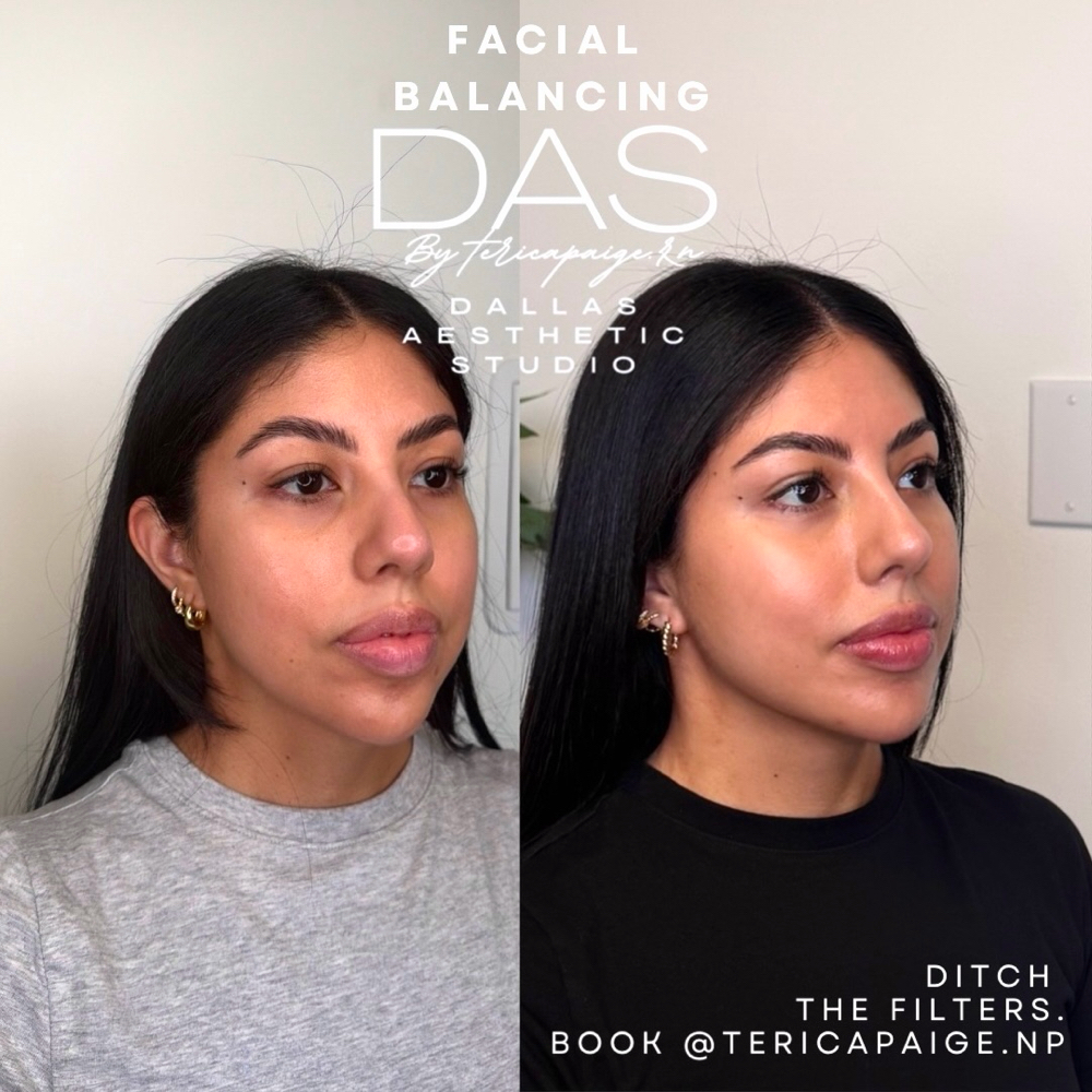 Chin Shadow Filler at Dallas Aesthetic Studio in Dallas, TX