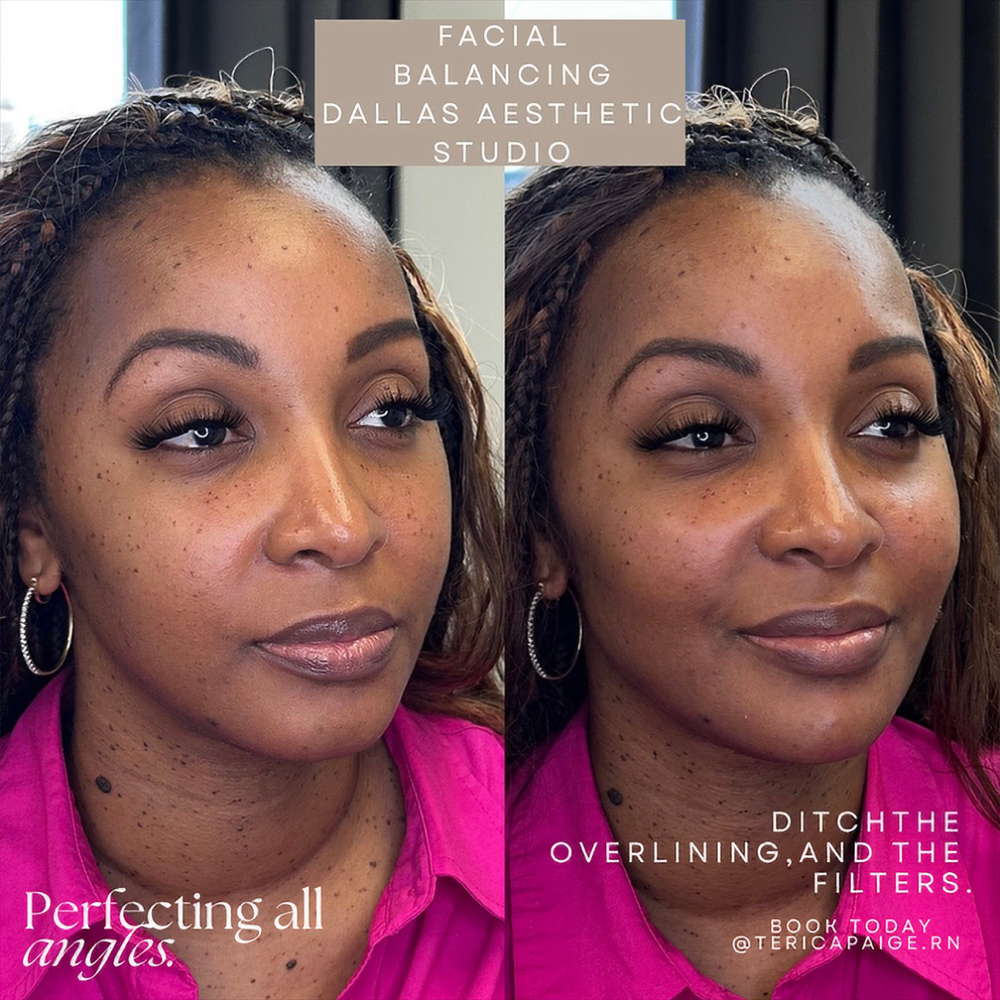 Chin Shadow Filler at Dallas Aesthetic Studio in Dallas, TX