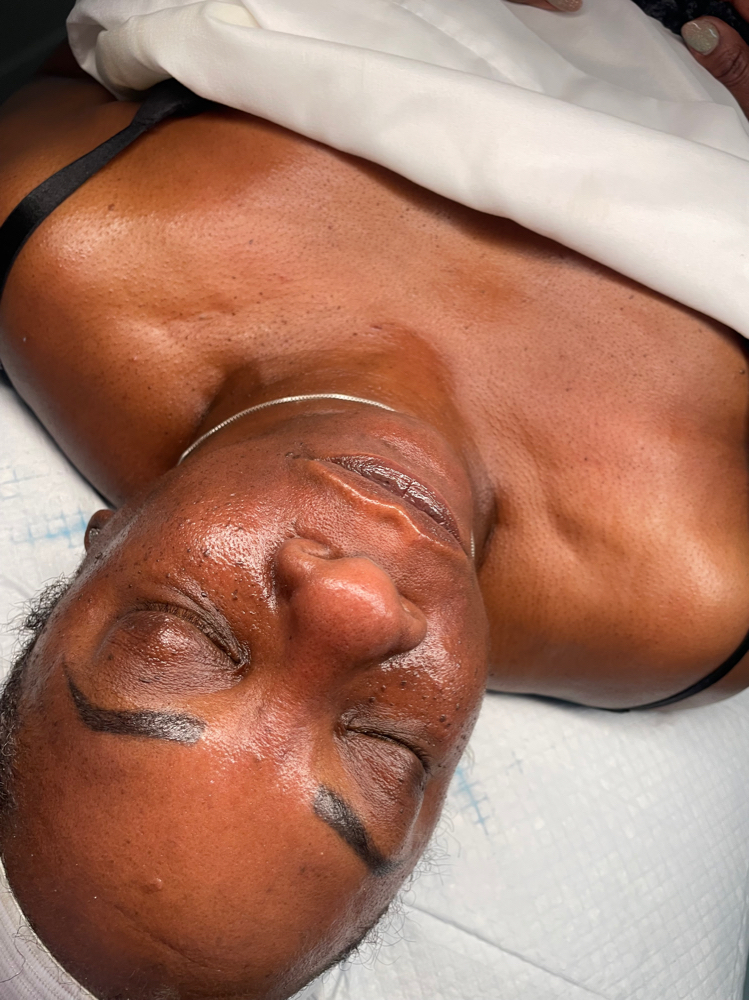 Microdermabrasion Facial