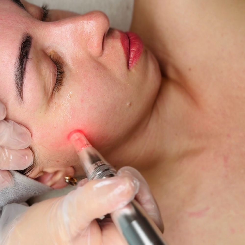 Nano-Needling Infusion at Skincare By Liliya in Sherman Oaks, CA