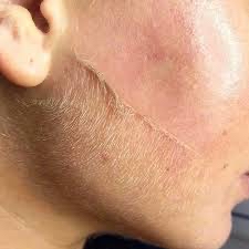Dermaplanig