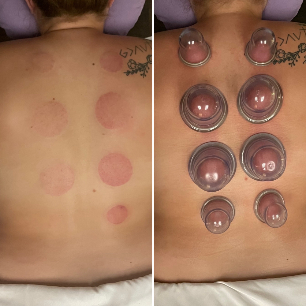 Cupping Add On