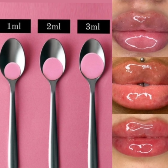 2 mL Lip Fillers