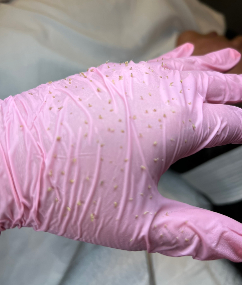 Acne Facial at Jisell Aesthetics in Houston, TX