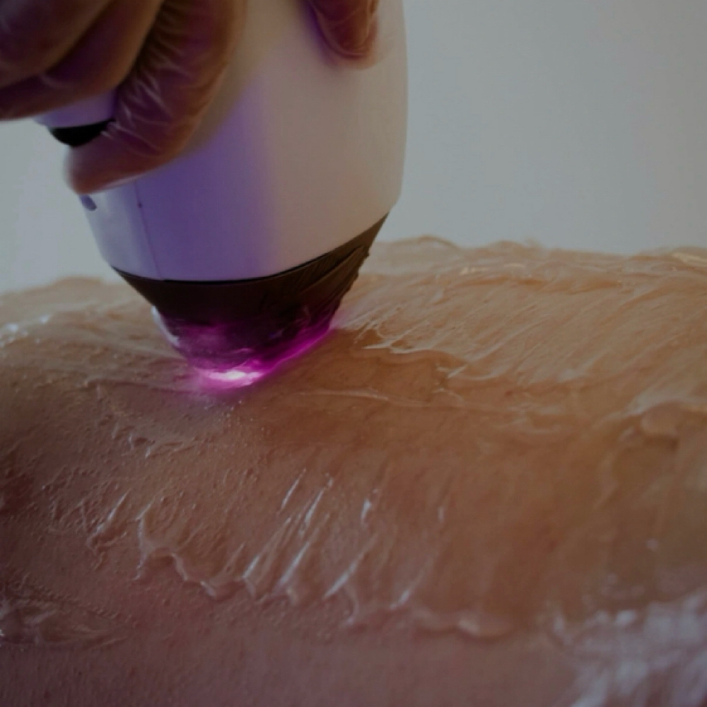 LASER HAIR REMOVAL at CE SKIN GARDEN in Middletown, NY