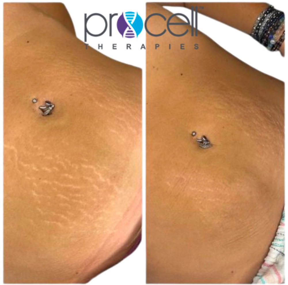 Stretch Mark SnatchBack Series