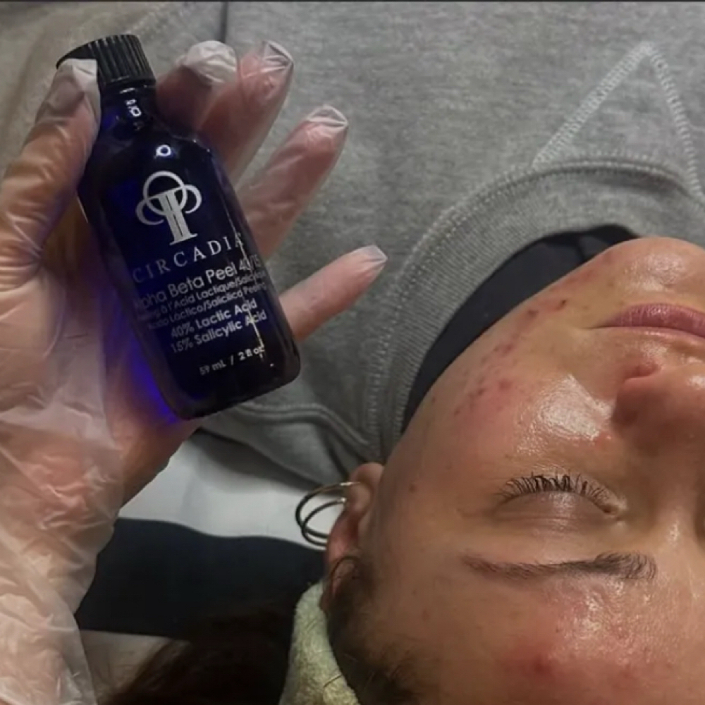Chemical Peels