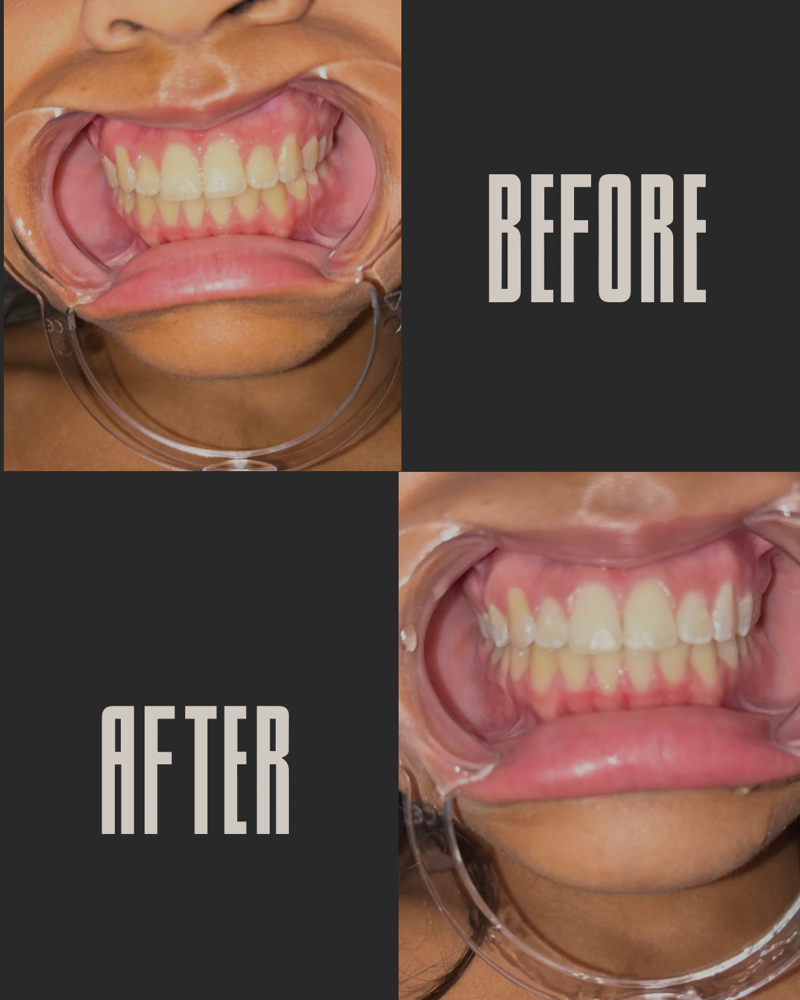 40 min teeth whitening session