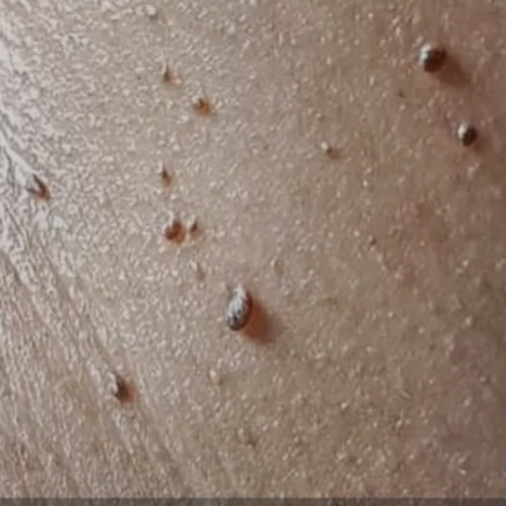 Skin Tag Removal at Elite IV and Wellness in Cerritos, CA