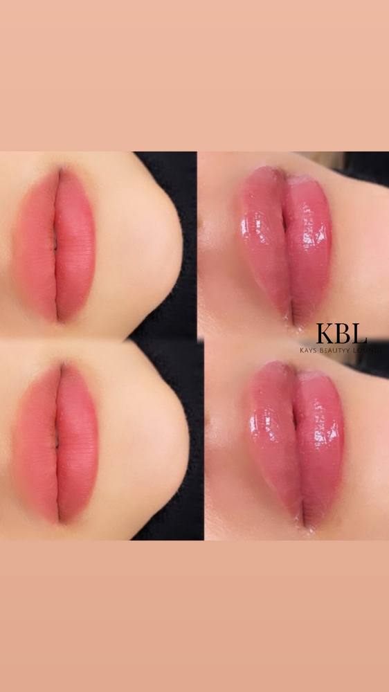 1ml Needless Lip Filler Apr Promo