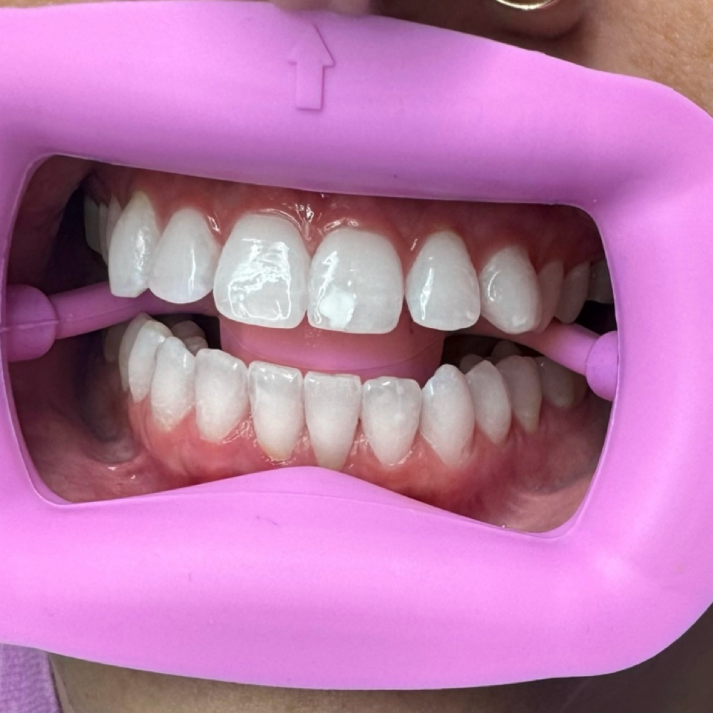 30 Min Whitening Session at RoCo Aesthetics & Wellness in Mayodan, NC