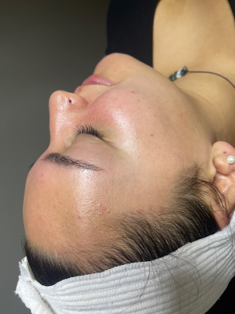 Chemical Peel And Dermaplane