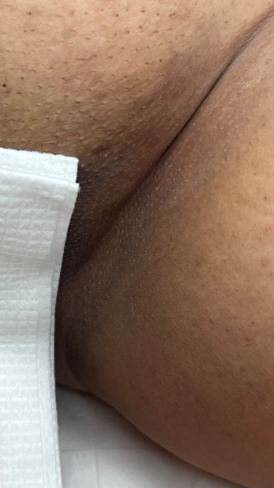 Bikini Line (1 Treatment)