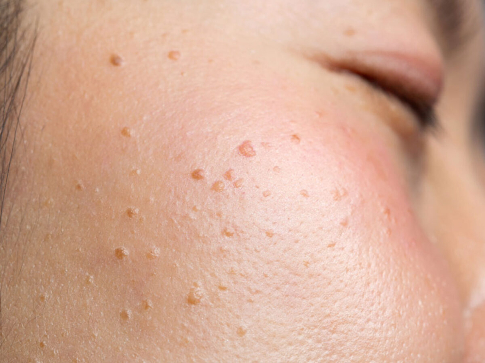 Keratosis Removal