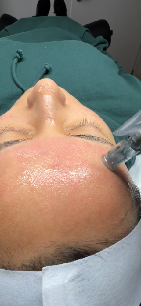 Microneedling