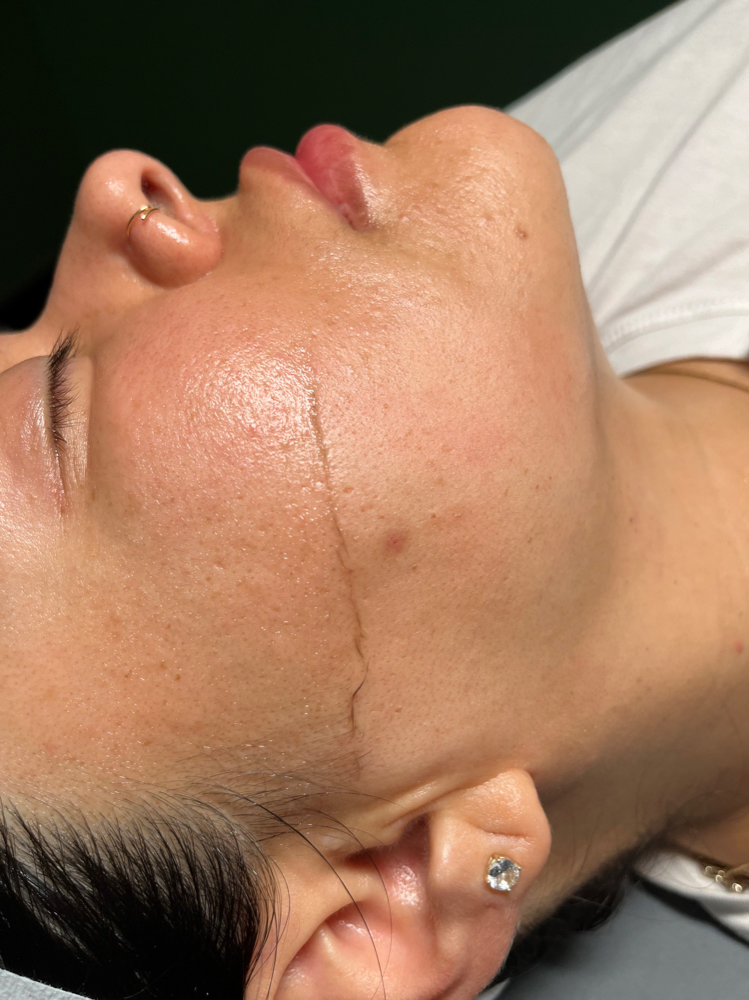 Dermaplane Only