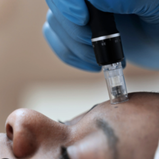 Microneedling at OD Medical Skin & Hair Sanctuary - Brooklyn in Brooklyn, NY
