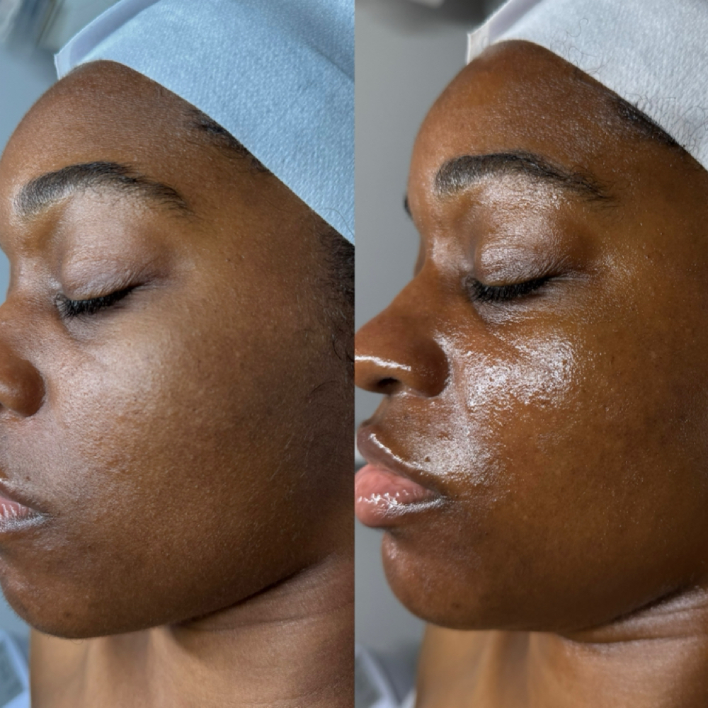 Microneedling Package 2 at Oasiah Aesthetics in New York, NY