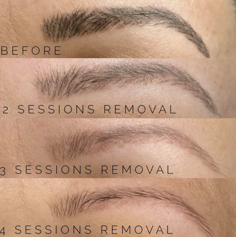 Eyebrow Tattoo Removal